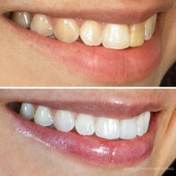 Beverly Hills Dental Song Cosmetic Dentist: Porcelain Veneers, Teeth Whitening, Invisalign