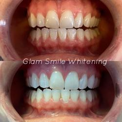 Glam Smile Whitening and Beauty Spa