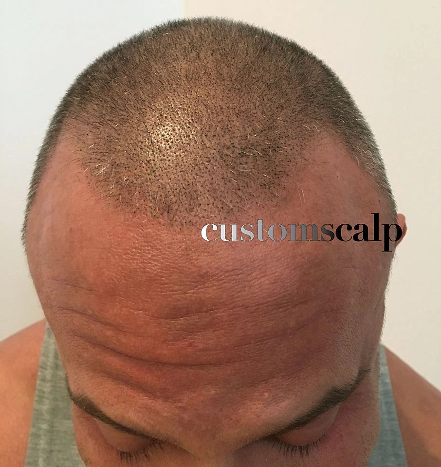 CustomScalp